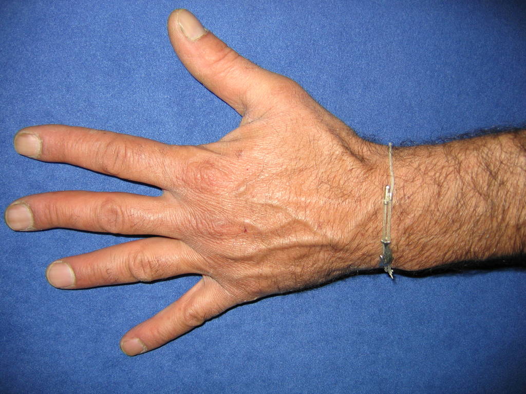 Il trattamento di pigmentary nota su rimedi di gente di mani
